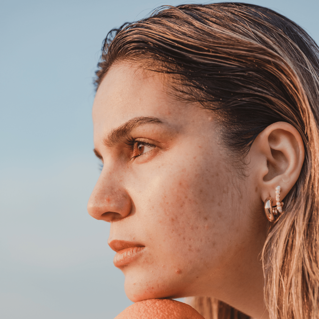 traitements naturels et approche holistique pour soigner l'acné hormonale