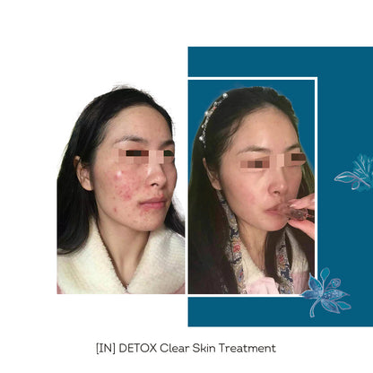 [IN] DETOX Clear Skin Cure 